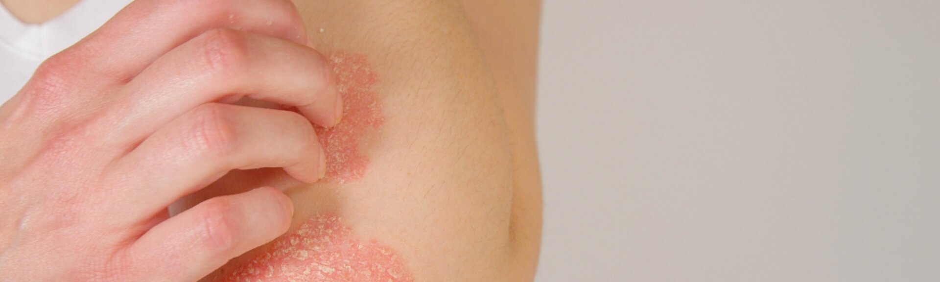Nurturing Your Skin with Smart Eczema Care