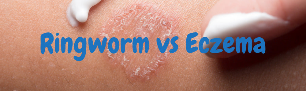ringworm vs eczema