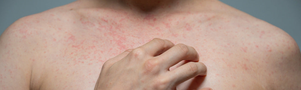 contact dermatitis rash on male chest