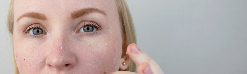 woman with dry skin on her face