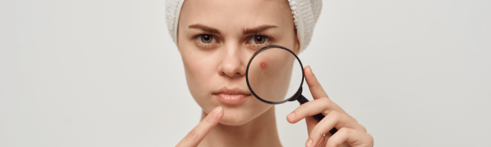 Skincare Habits That Make Acne Worse